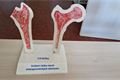 Tichý zloděj kostí – osteoporóza (4)
